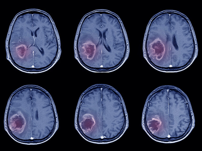 Leki psychiatryczne zmniejszają częstość nowotworów mózgu